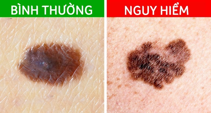 5 tín hiệu từ nốt ruồi cảnh báo ung thư đang tiềm ẩn dưới làn da - VietNamNet