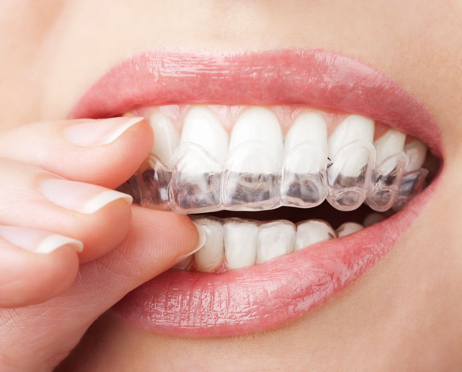 Niềng răng trong suốt có phải nhổ răng không? | Vinmec
